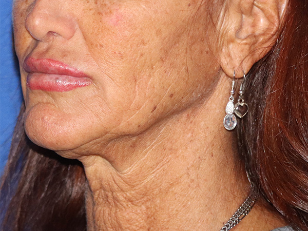 Neck Lift Before & After Gallery - Patient 141494256 - Image 1