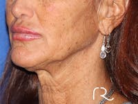 Facelift Before & After Gallery - Patient 141493963 - Image 1