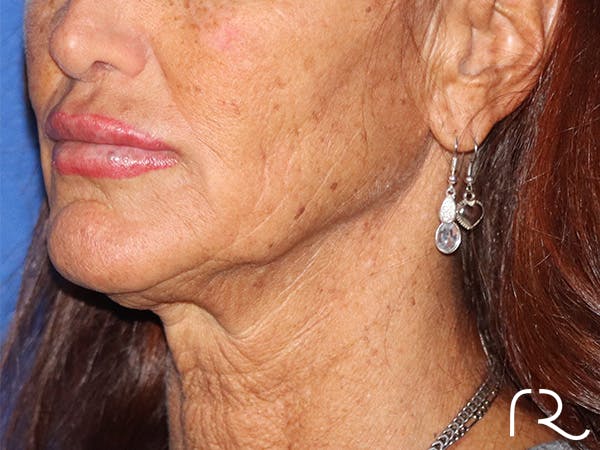 Neck Lift Before & After Gallery - Patient 141494256 - Image 1