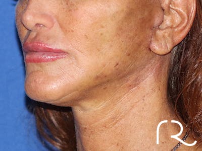 Neck Lift Before & After Gallery - Patient 141494256 - Image 2