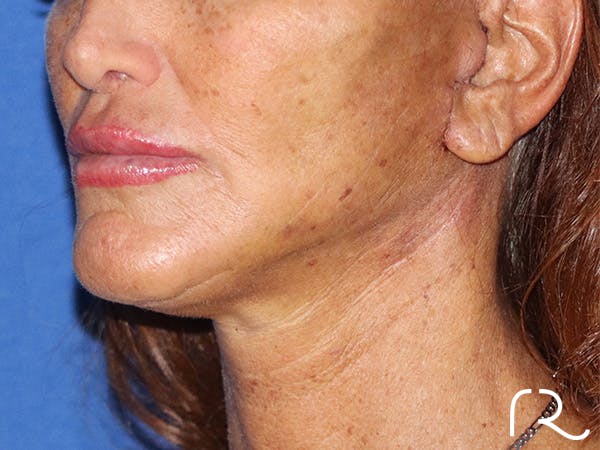 Facelift Before & After Gallery - Patient 141493963 - Image 2