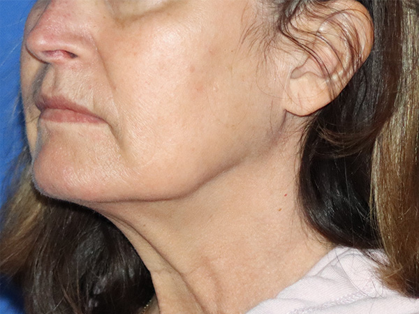 Neck Lift Before & After Gallery - Patient 141494255 - Image 1
