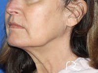 Neck Lift Before & After Gallery - Patient 141494255 - Image 1