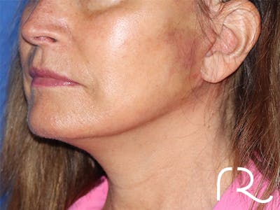 Facelift Before & After Gallery - Patient 141493961 - Image 2