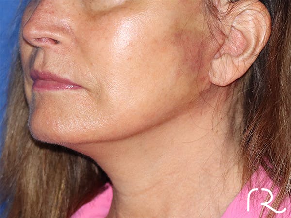 Facelift Before & After Gallery - Patient 141493961 - Image 2
