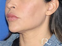 Facelift Before & After Gallery - Patient 141493960 - Image 1