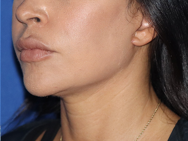 Neck Lift Before & After Gallery - Patient 141494254 - Image 2