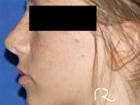 Rhinoplasty Before & After Gallery - Patient 141494266 - Image 1