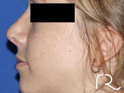 Rhinoplasty Before & After Gallery - Patient 141494266 - Image 2