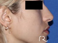 Revision Rhinoplasty Before & After Gallery - Patient 141494268 - Image 1