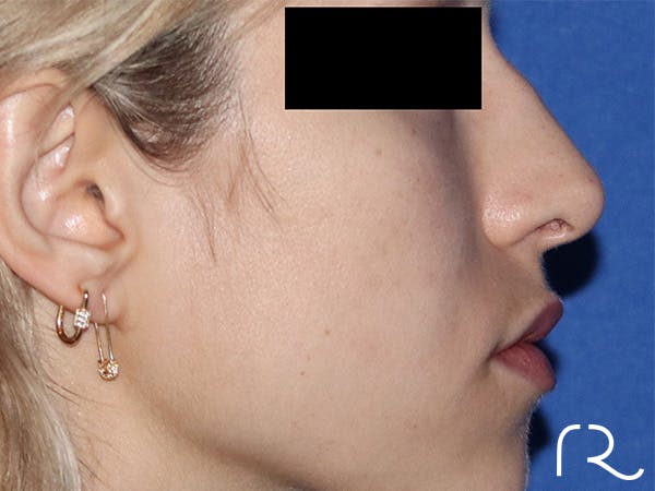 Revision Rhinoplasty Before & After Gallery - Patient 141494268 - Image 1