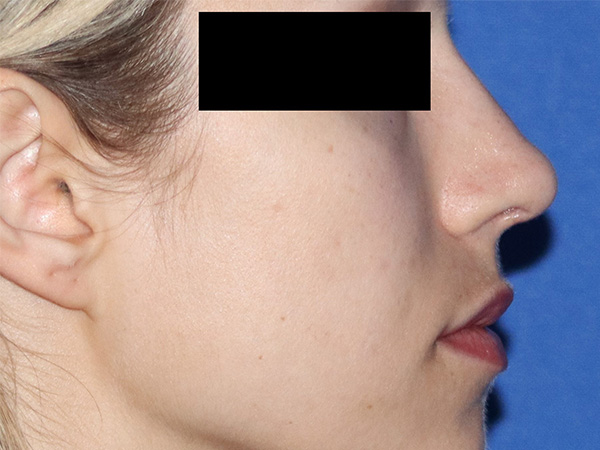 Revision Rhinoplasty Before & After Gallery - Patient 141494268 - Image 2