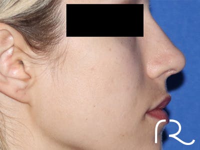 Revision Rhinoplasty Before & After Gallery - Patient 141494268 - Image 2