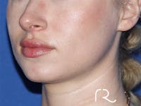 Rhinoplasty Before & After Gallery - Patient 141548357 - Image 1