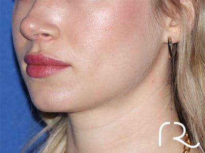Rhinoplasty Before & After Gallery - Patient 141548357 - Image 2