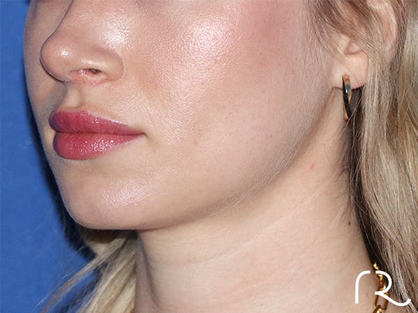 Rhinoplasty Before & After Gallery - Patient 141548357 - Image 2