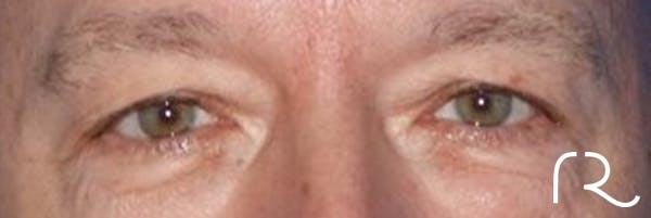 Eyelid Surgery Before & After Gallery - Patient 141785968 - Image 1