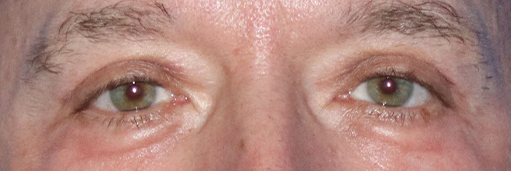 Eyelid Surgery Before & After Gallery - Patient 141785968 - Image 2