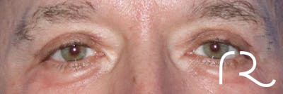 Eyelid Surgery Before & After Gallery - Patient 141785968 - Image 2
