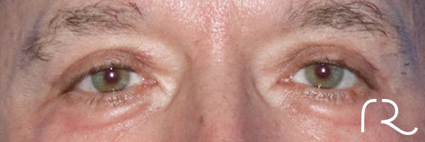 Eyelid Surgery Before & After Gallery - Patient 141785968 - Image 2
