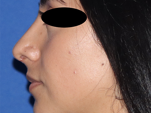Rhinoplasty Before & After Gallery - Patient 141786018 - Image 4