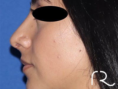 Rhinoplasty Before & After Gallery - Patient 141786018 - Image 4