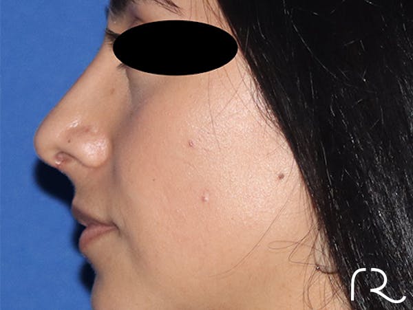 Rhinoplasty Before & After Gallery - Patient 141786018 - Image 4
