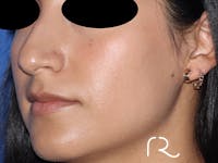 Rhinoplasty Before & After Gallery - Patient 141786018 - Image 1