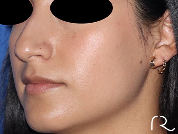 Rhinoplasty Before & After Gallery - Patient 141786018 - Image 1