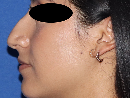 Rhinoplasty Before & After Gallery - Patient 141786018 - Image 3
