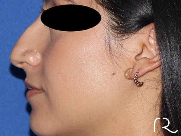 Rhinoplasty Before & After Gallery - Patient 141786018 - Image 3