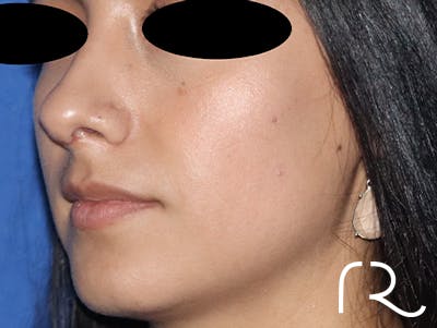 Rhinoplasty Before & After Gallery - Patient 141786018 - Image 2