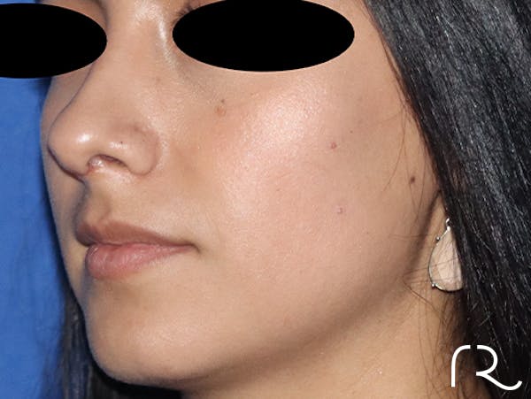 Rhinoplasty Before & After Gallery - Patient 141786018 - Image 2