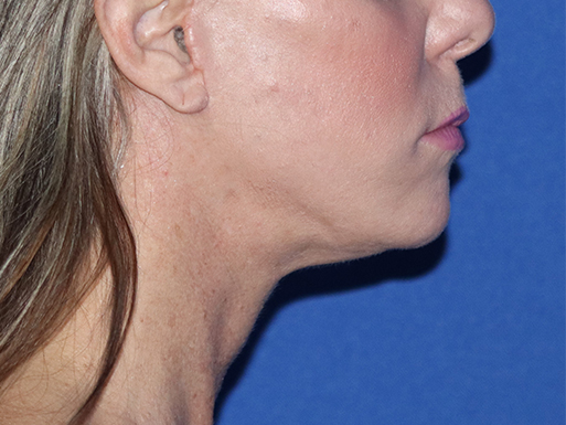 Facelift Before & After Gallery - Patient 143289761 - Image 4