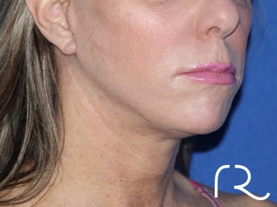 Facelift Before & After Gallery - Patient 143289761 - Image 4