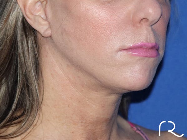 Neck Lift Before & After Gallery - Patient 143289757 - Image 2
