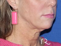 Neck Lift Before & After Gallery - Patient 143289757 - Image 1