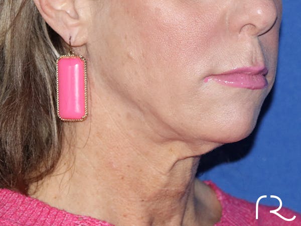 Facelift Before & After Gallery - Patient 143289761 - Image 3