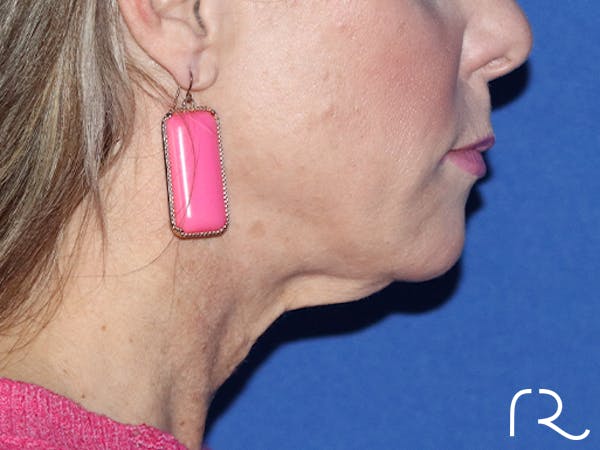 Neck Lift Before & After Gallery - Patient 143289757 - Image 3