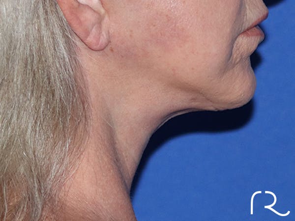 Facelift Before & After Gallery - Patient 143289769 - Image 2