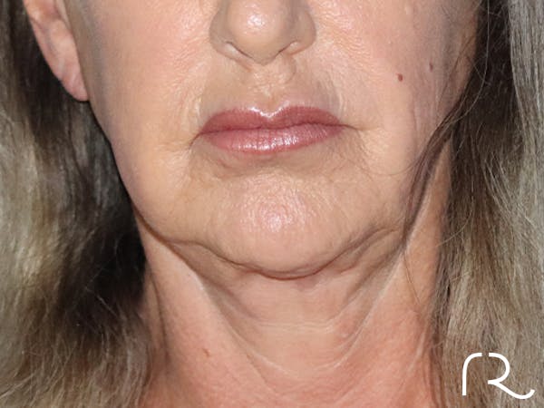 Facelift Before & After Gallery - Patient 143289769 - Image 3
