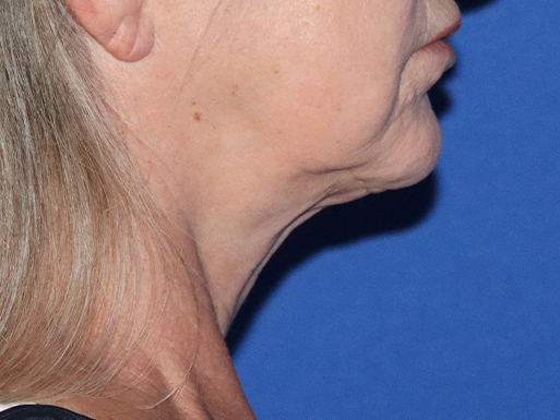 Neck Lift Before & After Gallery - Patient 143289775 - Image 1