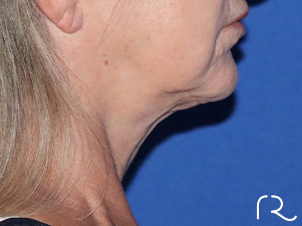 Facelift Before & After Gallery - Patient 143289769 - Image 1