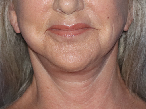 Facelift Before & After Gallery - Patient 143289769 - Image 4
