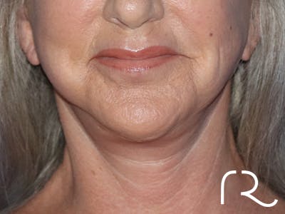 Facelift Before & After Gallery - Patient 143289769 - Image 4