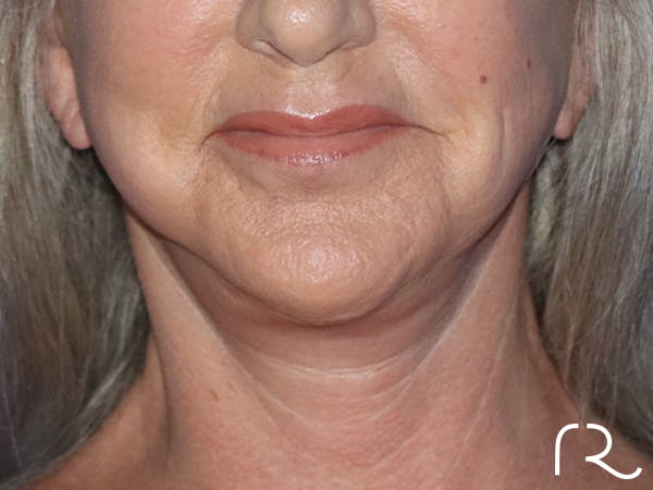 Neck Lift Before & After Gallery - Patient 143289775 - Image 4