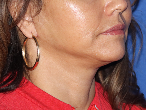 Facelift Before & After Gallery - Patient 143289810 - Image 2