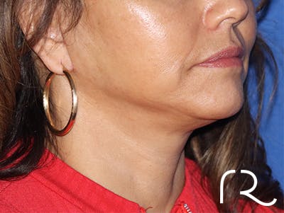 Neck Lift Before & After Gallery - Patient 143289783 - Image 2