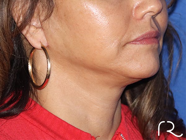 Facelift Before & After Gallery - Patient 143289810 - Image 2