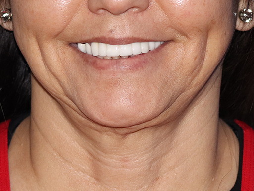 Facelift Before & After Gallery - Patient 143289810 - Image 3